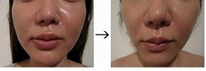ウルトラアクセントによる小顔治療の症例写真
