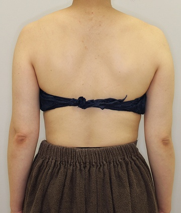 クールスカルプティングの症例写真　二の腕（治療前背面） 360px