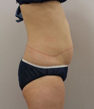クールスカルプティング治療　下腹部（治療前）360px