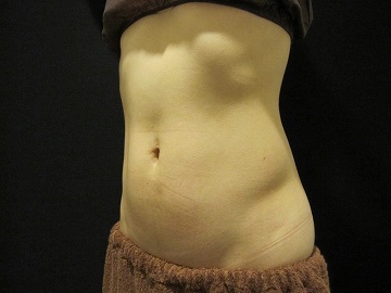 クールスカルプティング治療　下腹部＋側腹部（治療前）360px