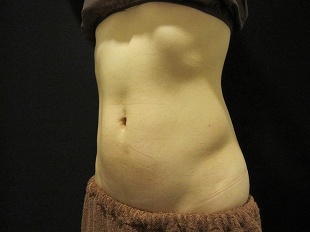 クールスカルプティング治療　下腹部＋側腹部（治療前）310px