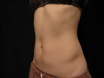 クールスカルプティング治療　下腹部＋側腹部（施術２ヶ月後）360px