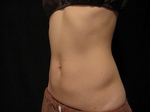 クールスカルプティング治療　下腹部＋側腹部（施術２ヶ月後）310px