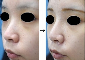 Ｉ型プロテーゼ挿入で鼻を高くした症例写真（手術前後　斜め横から）　300px