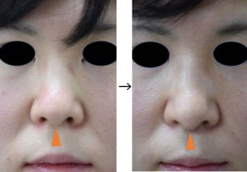 鼻柱延長術の症例写真（手術前後　正面１）
