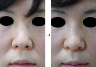 鼻柱延長術の症例写真（手術前後　正面２）