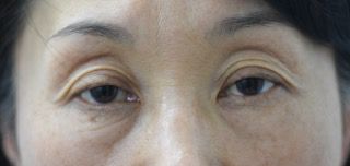 腱膜性眼瞼下垂手術の症例写真（両目とも保険適応の事例：手術前）320px