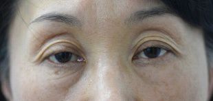 腱膜性眼瞼下垂手術の症例写真（両目とも保険適応の事例：手術前）310px