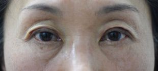 腱膜性眼瞼下垂手術の症例写真（両目とも保険適応の事例：手術直後）310px