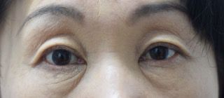 腱膜性眼瞼下垂手術の症例写真（両目とも保険適応の事例：手術から１ヶ月後）320px
