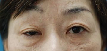 腱膜性眼瞼下垂手術の症例写真（片目のみ保険適応の事例：手術前）360px