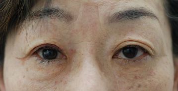 腱膜性眼瞼下垂手術の症例写真（片目のみ保険適応の事例：手術直後）360px
