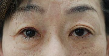 腱膜性眼瞼下垂手術の症例写真（片目のみ保険適応の事例：手術直後）360px