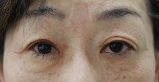 腱膜性眼瞼下垂手術の症例写真（片目のみ保険適応の事例：手術直後）310px