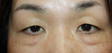 眼瞼下垂手術の症例写真（手術前）　360px