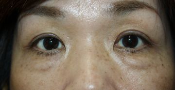 眼瞼下垂手術の症例写真（手術から６ヶ月後）　360px