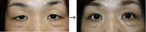 眼瞼下垂（保険適応）の症例写真