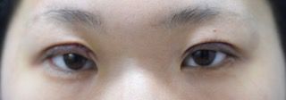 自由診療による眼瞼下垂手術の症例写真（目ヂカラをアップさせて瞳をパッチリと大きく見せたい：手術直後）320px