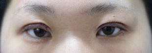 自由診療による眼瞼下垂手術の症例写真（目ヂカラをアップさせて瞳をパッチリと大きく見せたい：手術直後）310px