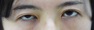 先天性眼瞼下垂手術の症例写真（手術前）　320px