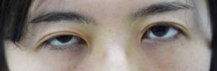 先天性眼瞼下垂手術の症例写真（手術前）　310px
