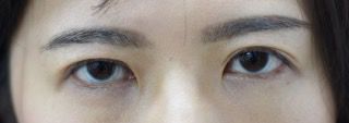 先天性眼瞼下垂手術の症例写真（手術から３ヶ月目）　320px
