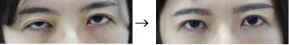 先天性眼瞼下垂手術の症例写真