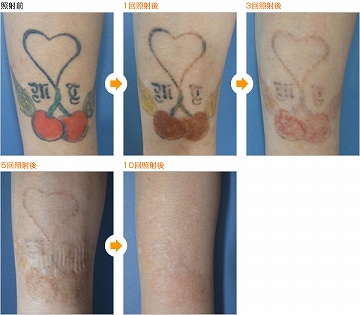 レーザーカラー刺青除去（治療前）360px