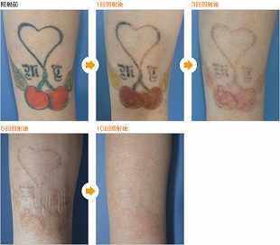 レーザーカラー刺青除去（治療前）310px