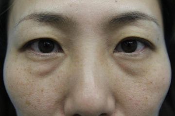 目の下にヒアルロン酸注射＋ウルセラアイ（治療前）　360px