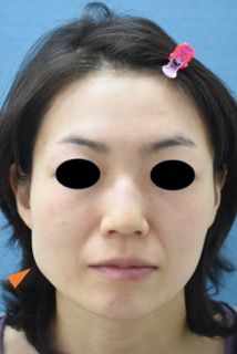顔の左右バランスを整えるエラボトックス（治療前）　214px