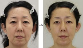 目の下くま手術（脱脂＋リポトランスファー＋脂肪注入）の症例写真