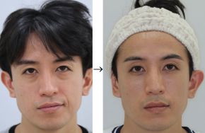 男性目の下くま手術（脱脂＋リポトランスファー＋脂肪注入）の症例写真