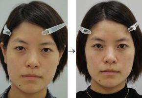 目の下くま手術（脱脂＋リポトランスファー＋脂肪注入）の症例写真