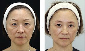 眉毛下切開＋目の下くま手術（脱脂＋リポトランスファー＋脂肪注入）の症例写真