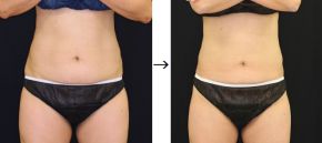 ゼルティックによる下腹部痩身の症例写真