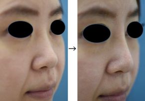 鼻プロテーゼ（鼻スジを高くする）の症例写真