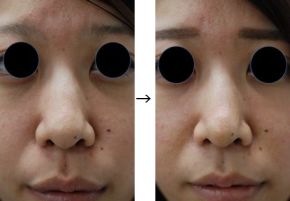 鼻尖修正（鼻先を細くする）の症例写真
