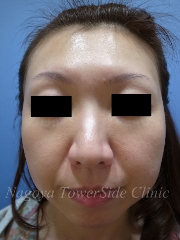 メスを使わない頬のたるみ複合治療の症例写真（治療前）　360px