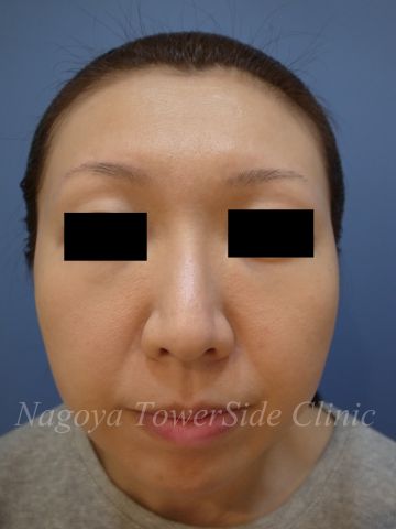 メスを使わない頬のたるみ複合治療の症例写真（治療後）　360px