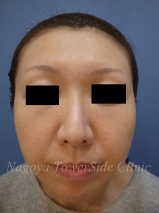 メスを使わない頬のたるみ複合治療の症例写真（治療後）　310px
