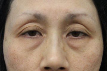 目の下は脱脂＋マイクロCRF脂肪注入、目の上は眼瞼下垂手術の症例写真（手術前）　360px