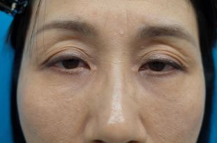 目の下は脱脂＋マイクロCRF脂肪注入（手術から3ヶ月後）　310px
