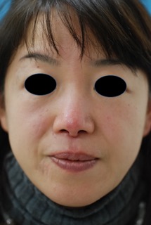 光照射機器アイコンを使用した赤ら顔治療の症例写真（治療前）215px