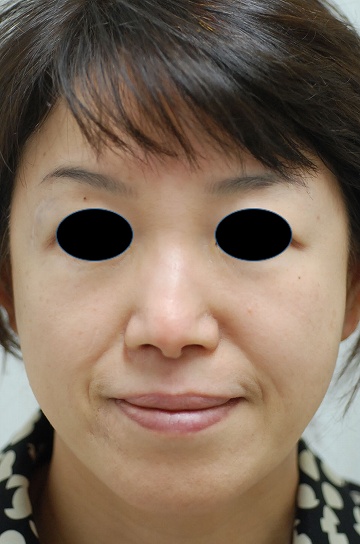 光照射機器アイコンを使用した赤ら顔治療の症例写真（５回照射後）360px