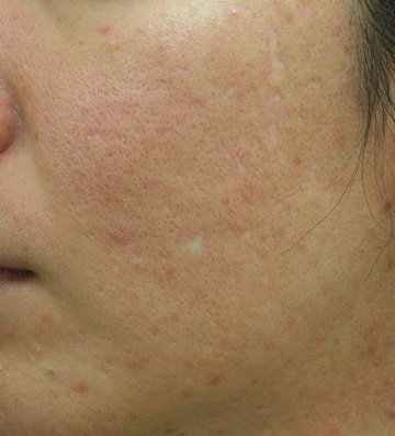 浅いニキビ跡＋毛穴拡大タイプのニキビ跡治療症例写真（治療前左側）360px