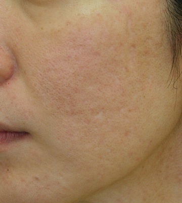 浅いニキビ跡＋毛穴拡大タイプのニキビ跡治療症例写真（治療４回後左側）360px
