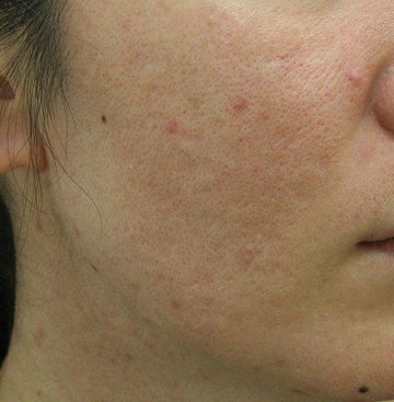 浅いニキビ跡＋毛穴拡大タイプのニキビ跡治療症例写真（治療前右側）360px