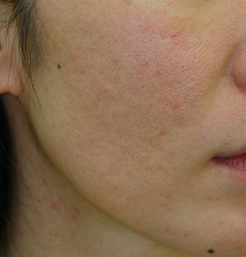 浅いニキビ跡＋毛穴拡大タイプのニキビ跡治療症例写真（治療４回後右側）360px