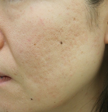 広く浅いニキビ跡＋毛穴拡大タイプのニキビ跡治療症例写真（治療前左側）360px